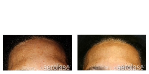 After 1 Treatment combined with TCA Peel 